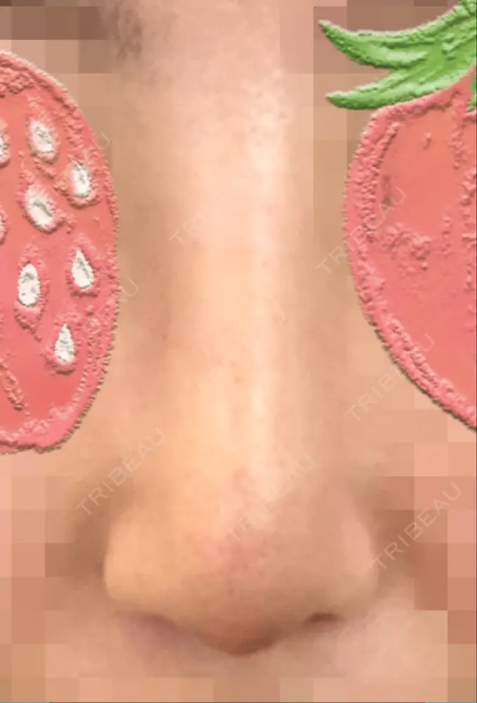 鼻尖形成（切開） / 軟骨移植 / ワシ鼻修正・ハンプ切除 麹町皮ふ科・形成外科クリニック DAY 10 メイン用