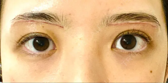 眉下切開 Taide Suenaga Clinic（タイデスエナガクリニック） DAY 19 メイン用