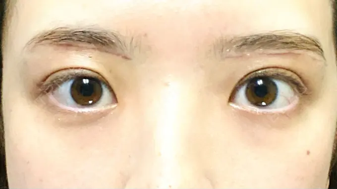 眉下切開 Taide Suenaga Clinic（タイデスエナガクリニック） DAY 22 メイン用