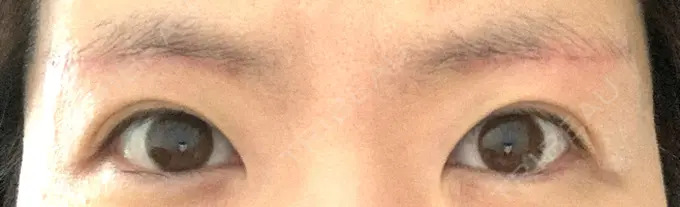 眉下切開 城本クリニック 福岡院 DAY 56 メイン用