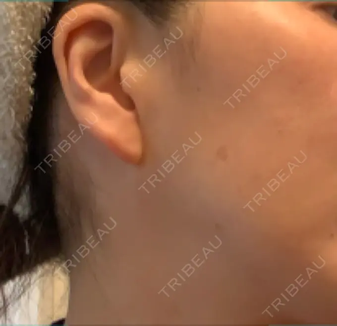 ピーリング（ニキビ・毛穴） / イオン導入 / エレクトロポレーション / 毛穴洗浄（ハイドラフェイシャルなど） あおばクリニック 横浜院 DAY 7 メイン用