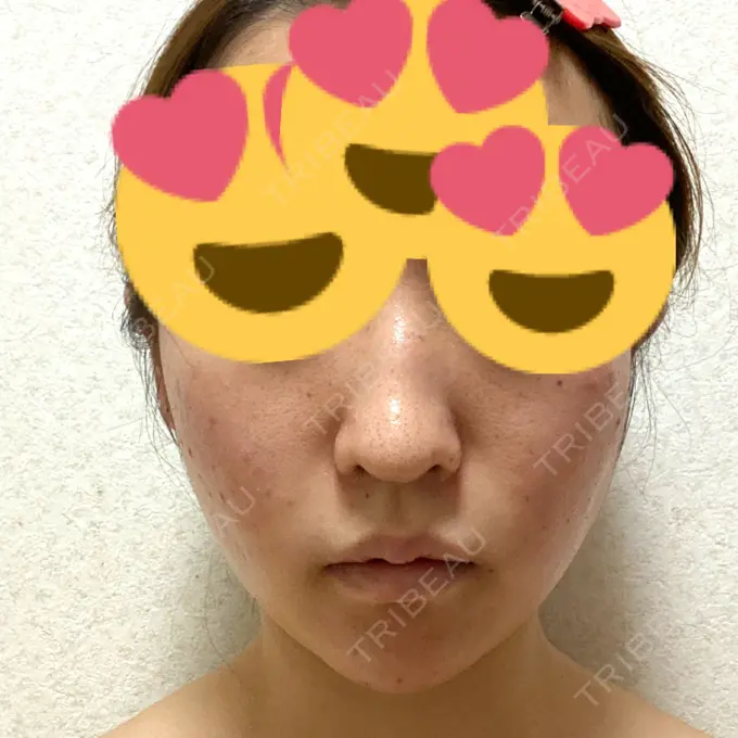 糸リフト / ボトックス（あご） / 肌ヒアルロン酸注入（たるみ・シワ改善） / ヒアルロン酸注入（あご） / ヒアルロン酸注入（唇） / ボトックス（口角） ルラ美容クリニック 新宿院 DAY 1 メイン用