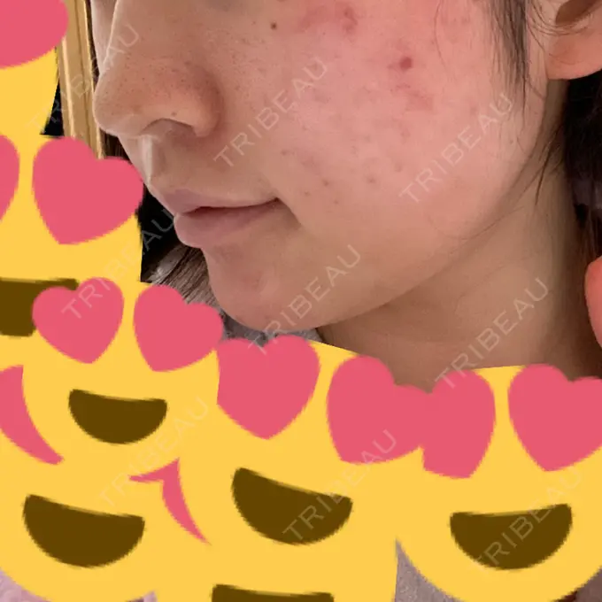 糸リフト / ボトックス（あご） / 肌ヒアルロン酸注入（たるみ・シワ改善） / ヒアルロン酸注入（あご） / ヒアルロン酸注入（唇） / ボトックス（口角） ルラ美容クリニック 新宿院 DAY 2 メイン用