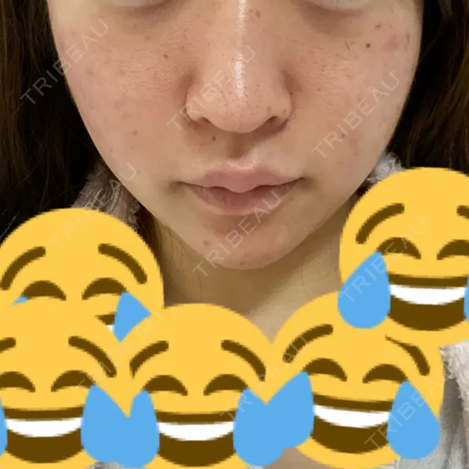 糸リフト / ボトックス（あご） / 肌ヒアルロン酸注入（たるみ・シワ改善） / ヒアルロン酸注入（あご） / ヒアルロン酸注入（唇） / ボトックス（口角） ルラ美容クリニック 新宿院 DAY 2 メイン用