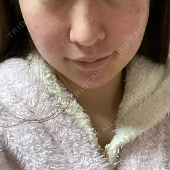 糸リフト / ボトックス（あご） / 肌ヒアルロン酸注入（たるみ・シワ改善） / ヒアルロン酸注入（あご） / ヒアルロン酸注入（唇） / ボトックス（口角） ルラ美容クリニック 新宿院 DAY 5 メイン用