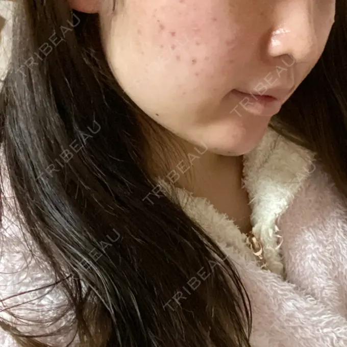 糸リフト / ボトックス（あご） / 肌ヒアルロン酸注入（たるみ・シワ改善） / ヒアルロン酸注入（あご） / ヒアルロン酸注入（唇） / ボトックス（口角） ルラ美容クリニック 新宿院 DAY 5 メイン用