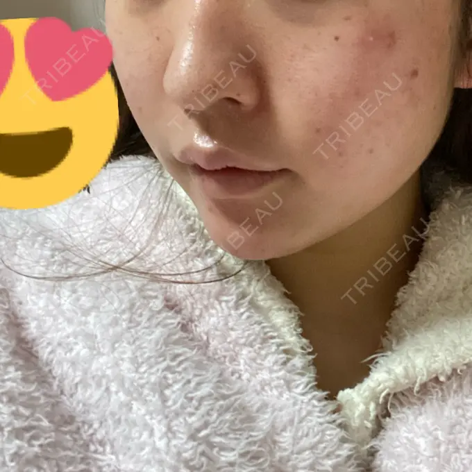 糸リフト / ボトックス（あご） / 肌ヒアルロン酸注入（たるみ・シワ改善） / ヒアルロン酸注入（あご） / ヒアルロン酸注入（唇） / ボトックス（口角） ルラ美容クリニック 新宿院 DAY 5 メイン用