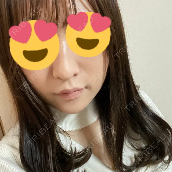 糸リフト / ボトックス（あご） / 肌ヒアルロン酸注入（たるみ・シワ改善） / ヒアルロン酸注入（あご） / ヒアルロン酸注入（唇） / ボトックス（口角） ルラ美容クリニック 新宿院 AFTER メイン用