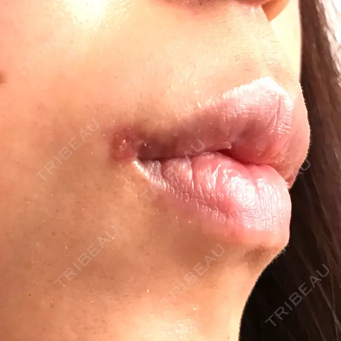 口角挙上 / その他（口元） eクリニック 金沢本院 DAY 30 メイン用