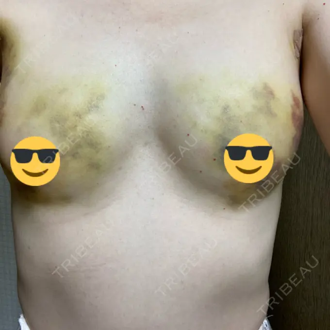 脂肪吸引（脚） / 豊胸（脂肪注入） THE CLINIC（ザ・クリニック） 名古屋院 DAY 3 メイン用