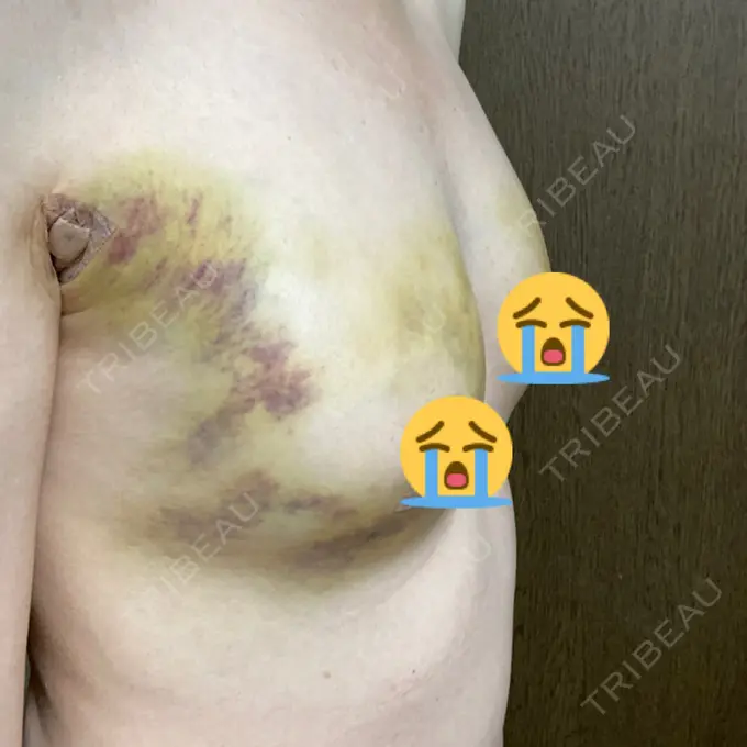 脂肪吸引（脚） / 豊胸（脂肪注入） THE CLINIC（ザ・クリニック） 名古屋院 DAY 3 メイン用