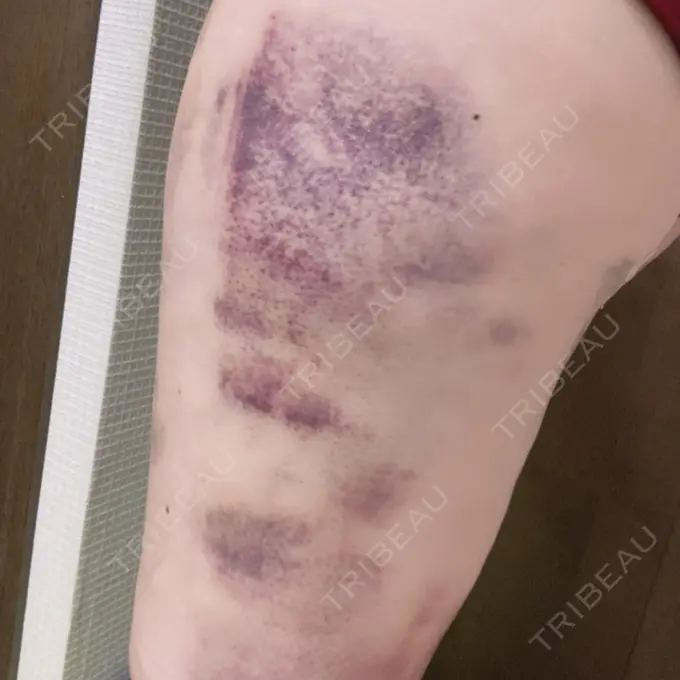 脂肪吸引（脚） / 豊胸（脂肪注入） THE CLINIC（ザ・クリニック） 名古屋院 DAY 3 メイン用