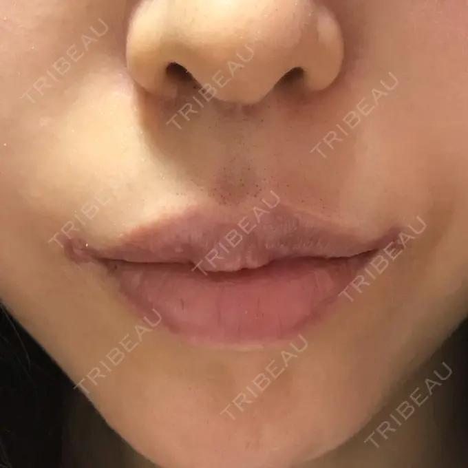 口角挙上 / その他（口元） eクリニック 金沢本院 DAY 16 メイン用