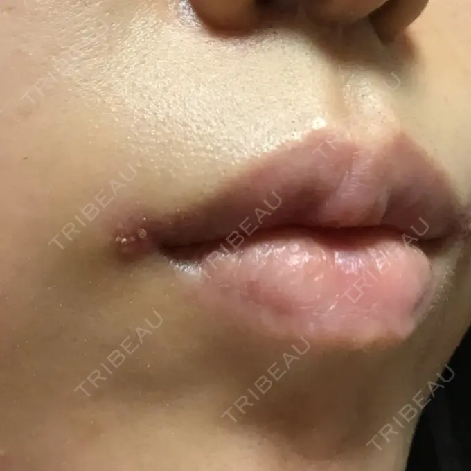 口角挙上 / その他（口元） eクリニック 金沢本院 DAY 16 メイン用