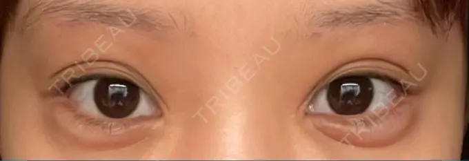 眉下切開 湘南美容クリニック 高田馬場院 DAY 61 メイン用