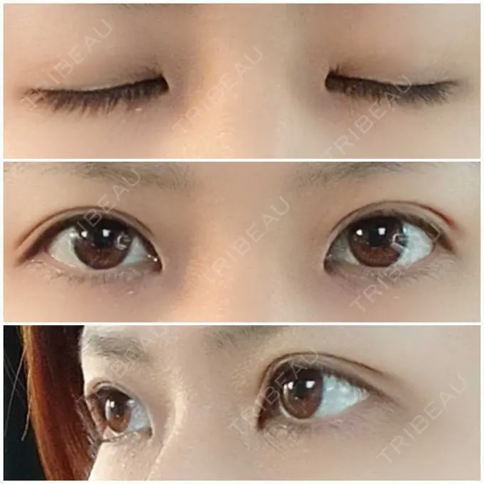 二重埋没 かわた美容クリニック AFTER メイン用