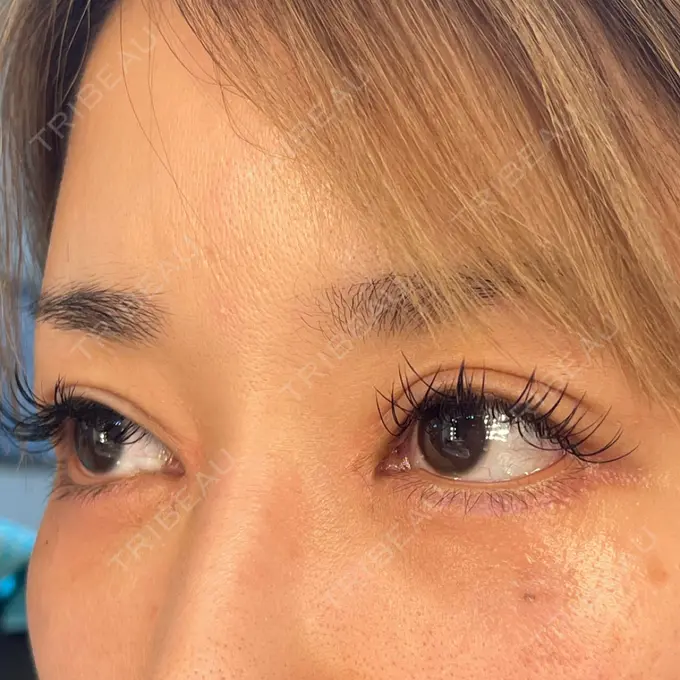 目頭切開 / 糸リフト / 目尻切開 / タレ目形成・グラマラスライン（切開） / メーラーファット除去 / ヒアルロン酸注入（涙袋） / ヒアルロン酸注入（あご） / ヒアルロン酸注入（唇） / ボトックス（口角） 大阪TAクリニック DAY 65 メイン用