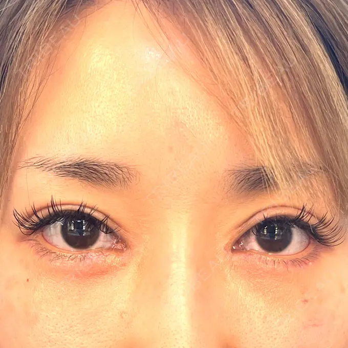 目頭切開 / 糸リフト / 目尻切開 / タレ目形成・グラマラスライン（切開） / メーラーファット除去 / ヒアルロン酸注入（涙袋） / ヒアルロン酸注入（あご） / ヒアルロン酸注入（唇） / ボトックス（口角） 大阪TAクリニック DAY 65 メイン用