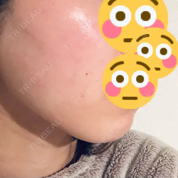 糸リフト 湘南美容クリニック 東京蒲田院 DAY 1 メイン用