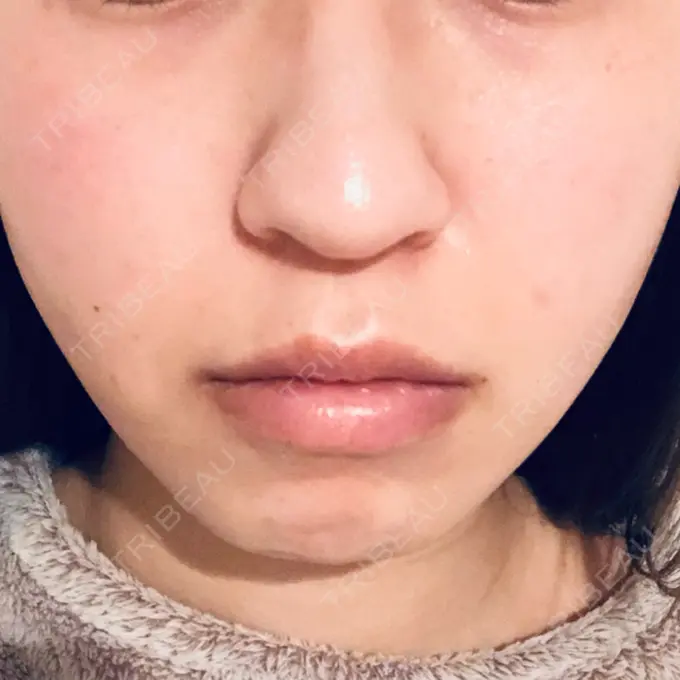 糸リフト 湘南美容クリニック 東京蒲田院 DAY 1 メイン用