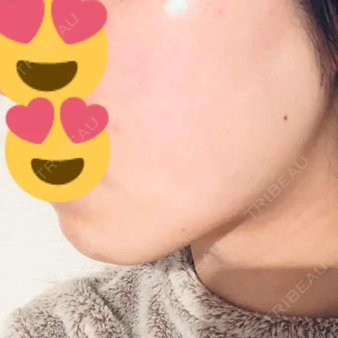 糸リフト 湘南美容クリニック 東京蒲田院 DAY 1 メイン用