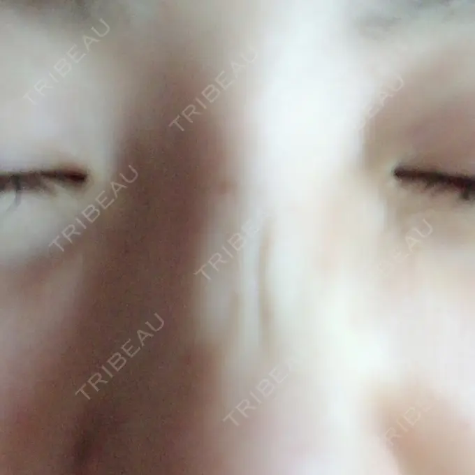 ボトックス（あご） 湘南美容クリニック 銀座院 DAY 9 メイン用