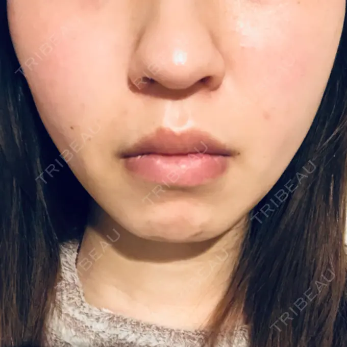 糸リフト 湘南美容クリニック 東京蒲田院 DAY 2 メイン用