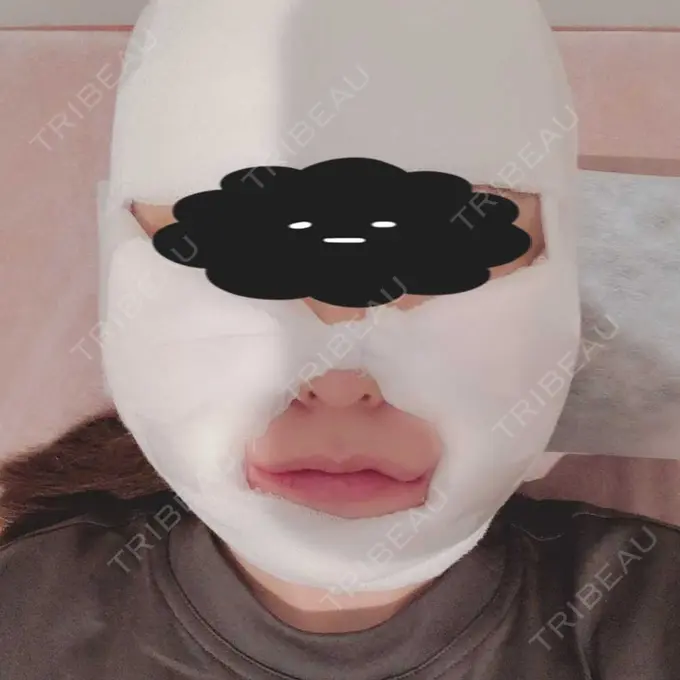 脂肪吸引（顔） みずほクリニック AFTER メイン用