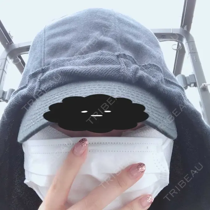 脂肪吸引（顔） みずほクリニック DAY 0 メイン用