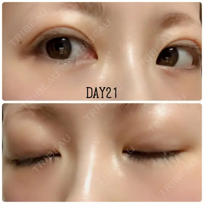 二重埋没 X CLINIC 恵比寿院 DAY 21 メイン用