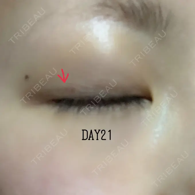 二重埋没 X CLINIC 恵比寿院 DAY 21 メイン用