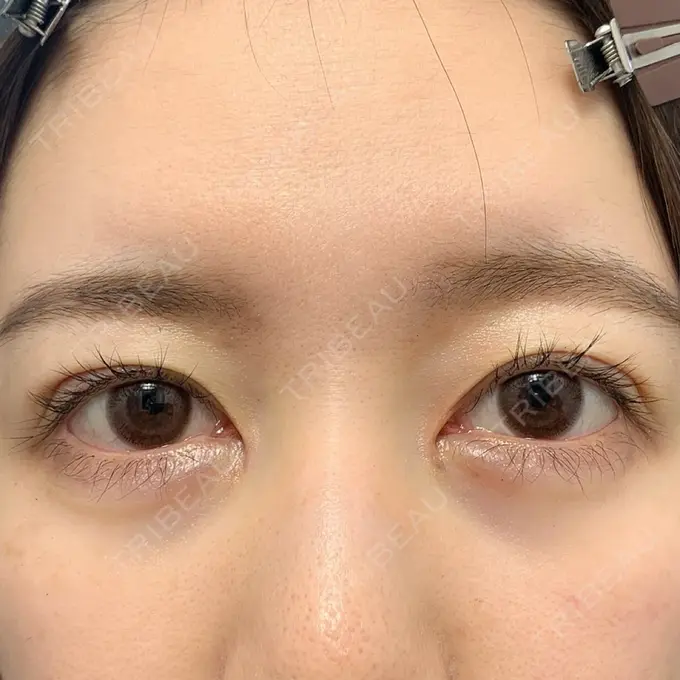 二重切開 / 目頭切開 心斎橋コムロ美容外科クリニック DAY 60 メイン用