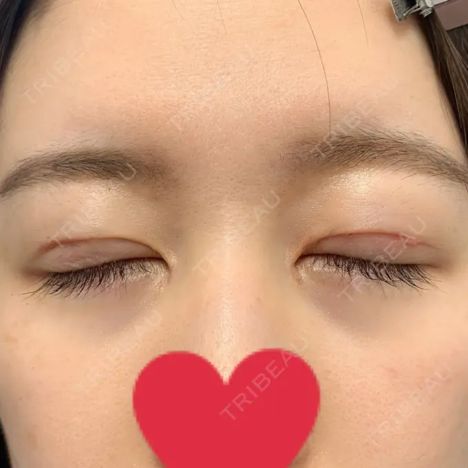 二重切開 / 目頭切開 心斎橋コムロ美容外科クリニック DAY 60 メイン用