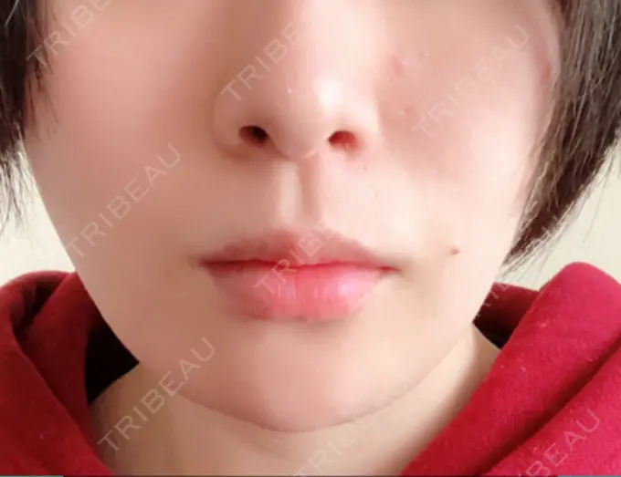 骨切り（あご） 仙台中央クリニック AFTER メイン用