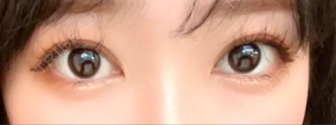 二重埋没 / ヒアルロン酸注入（目の下） EMMA CLINIC（エマクリニック） AFTER メイン用