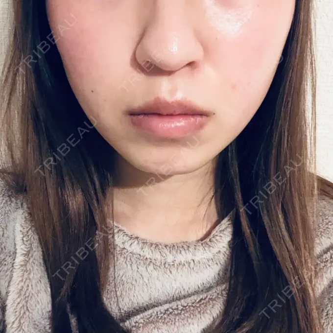 糸リフト 湘南美容クリニック 東京蒲田院 DAY 4 メイン用