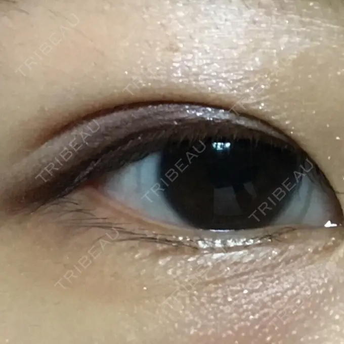 二重埋没 湘南美容クリニック 銀座院 DAY 61 メイン用