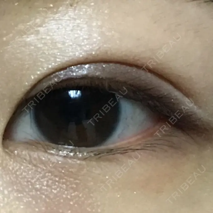 二重埋没 湘南美容クリニック 銀座院 DAY 61 メイン用