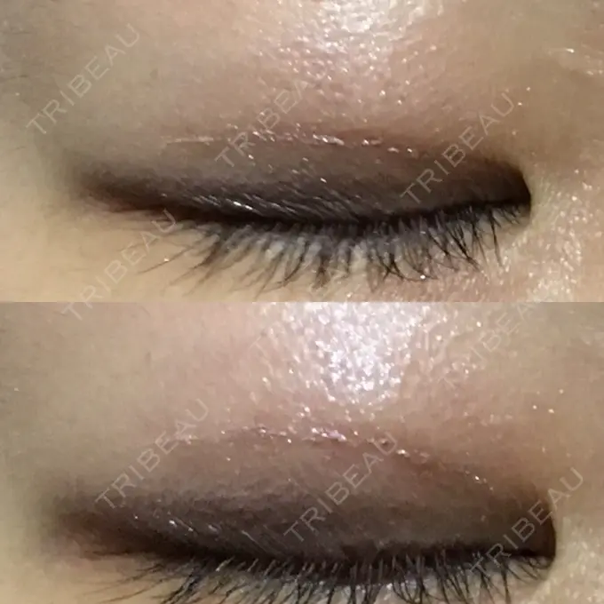 二重埋没 湘南美容クリニック 銀座院 DAY 61 メイン用