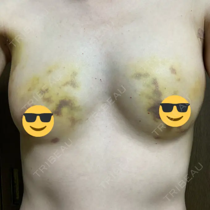 脂肪吸引（脚） / 豊胸（脂肪注入） THE CLINIC（ザ・クリニック） 名古屋院 DAY 8 メイン用