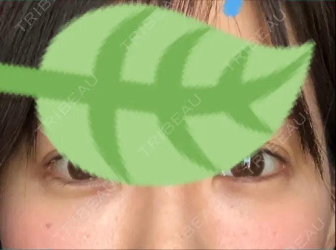 クマ治療 / 下まぶたの脂肪取り 韓国ST美容整形外科 DAY 28 メイン用