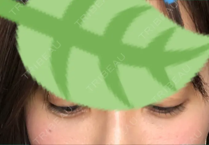 クマ治療 / 下まぶたの脂肪取り 韓国ST美容整形外科 DAY 28 メイン用