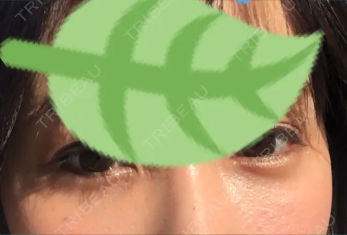 クマ治療 / 下まぶたの脂肪取り 韓国ST美容整形外科 DAY 32 メイン用