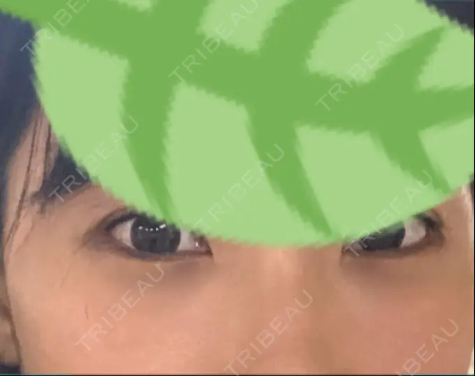 クマ治療 / 下まぶたの脂肪取り 韓国ST美容整形外科 DAY 43 メイン用