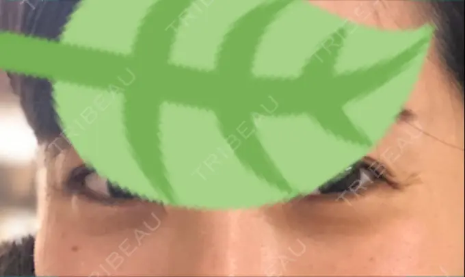 クマ治療 / 下まぶたの脂肪取り 韓国ST美容整形外科 DAY 43 メイン用