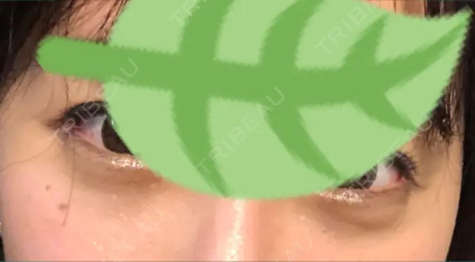 クマ治療 / 下まぶたの脂肪取り 韓国ST美容整形外科 DAY 56 メイン用