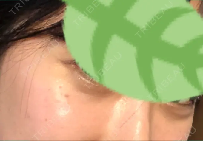 クマ治療 / 下まぶたの脂肪取り 韓国ST美容整形外科 DAY 56 メイン用