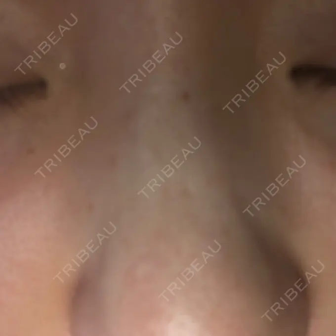 ボトックス（あご） 湘南美容クリニック 銀座院 DAY 10 メイン用