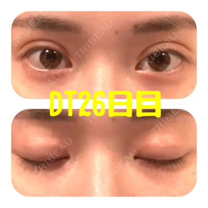 二重埋没 ハナビューティークリニック DAY 26 メイン用