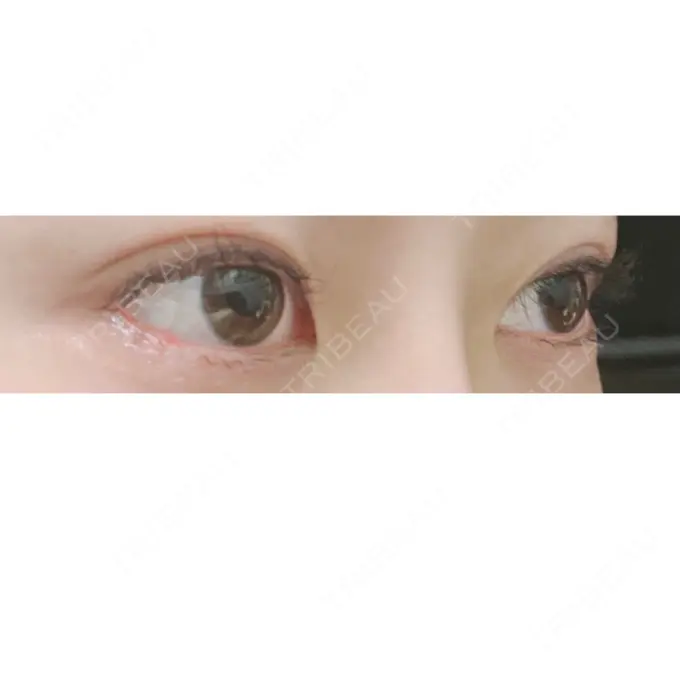 目尻切開 / タレ目形成・グラマラスライン（切開） A CLINIC（エークリニック） 銀座院 DAY 13 メイン用